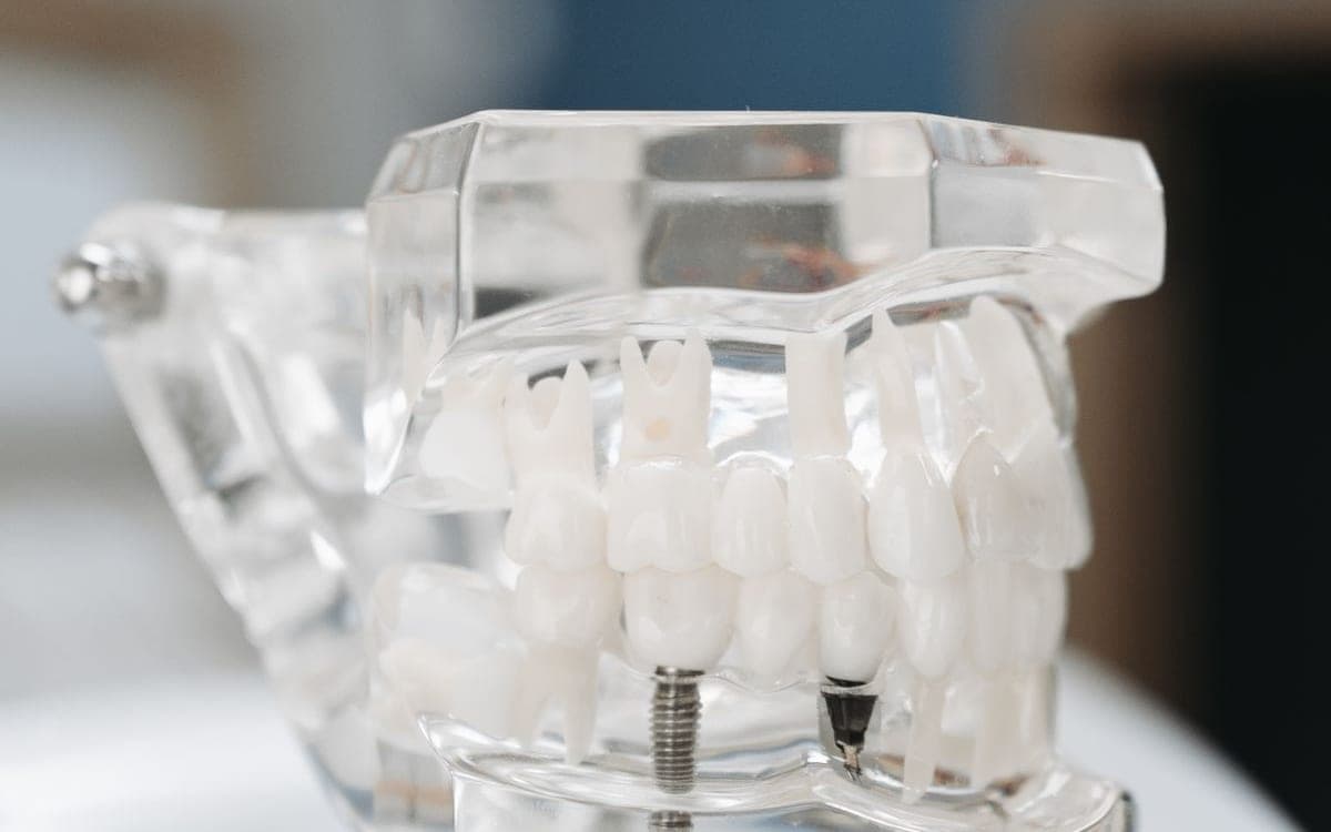 Şeffaf plastik çene modelinde dizili beyaz dişler ve implant vidaları